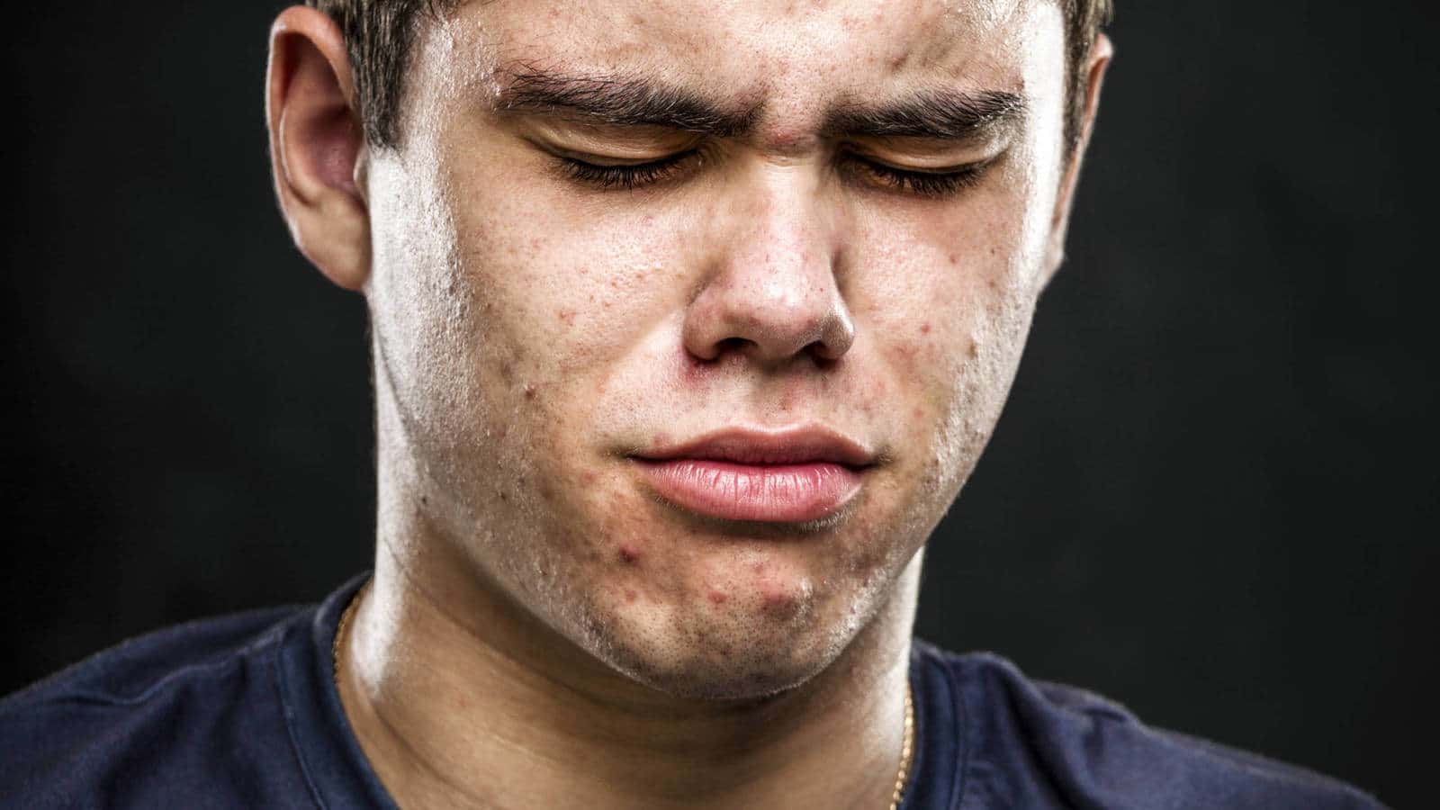 حب الشباب الكيسي: الأسباب والأعراض والعلاج الطبي - skin-beauty el efecto secundario de un medicamento contra el acne puede acabar con la virilidad - حب الشباب الكيسي: الأسباب والأعراض والعلاج الطبي