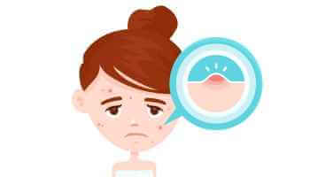 8 علاجات منزلية لعلاج البثور في الوجه ونصائح للوقاية - skin-beauty Acne 1024xبس1024 - 8 علاجات منزلية لعلاج البثور في الوجه ونصائح للوقاية