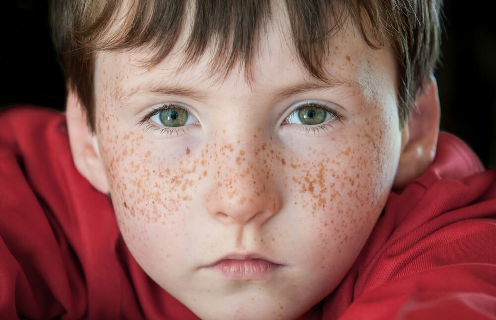 Freckles - العلاجات المنزلية للنمش Freckles ونصائح العناية الذاتية
