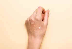 مرض تقشر الجلد : الأسباب والأعراض والعلاج الطبي - skin-beauty peeling skinvd feat 1 - مرض تقشر الجلد : الأسباب والأعراض والعلاج الطبي