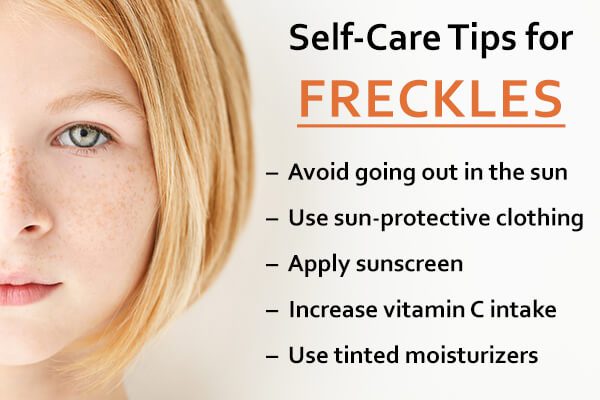 self care measures - العلاجات المنزلية للنمش Freckles ونصائح العناية الذاتية