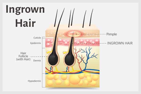 نمو الشعر تحت الجلد: الأسباب والأعراض والعلاج - %categories