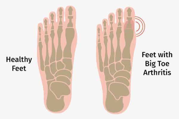التهاب المفصل في إصبع القدم الكبير: الأسباب والأعراض والتشخيص والإدارة - %categories