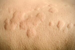 أسباب حكة الجسم المفاجئه وطريقة علاجها - skin-beauty حكة الجسم المفاجئه 300x199 - أسباب حكة الجسم المفاجئه وطريقة علاجها