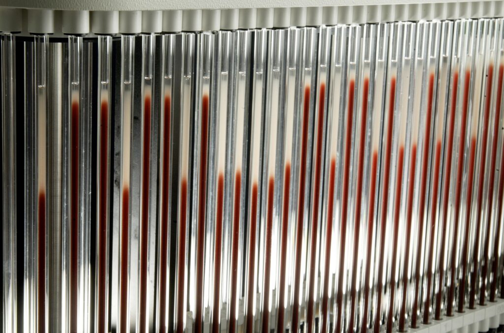 Causes et symptômes d'une vitesse de sédimentation élevée Haum le plus doux