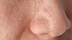 L'apparition de grains gras sous la peau sur le visage - allergie-immunité Tissu adipeux sous-cutané sur le visage 300x168 - l'apparition de dépôts graisseux sous-cutanés sur le visage
