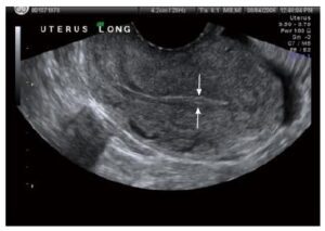 سماكة بطانة الرحم والحمل والعلاقة بينهما - womens-health بطانة الرحم والحمل 2 300x213 - سماكة بطانة الرحم والحمل والعلاقة بينهما