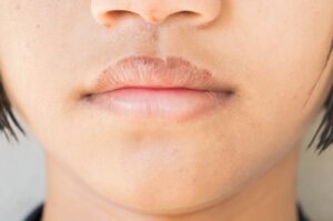 طريقة علاج تشقق الشفاه الدائم - skin-beauty علاج تشقق الشفاه الدائم 300x199 - طريقة علاج تشقق الشفاه الدائم