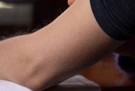 نتوءات على الذراعين (التقرن الشعري): العلاج والعلاجات المنزلية ونصائح العناية الذاتية - skin-beauty how to get rid of bumps oبيn arms feat - نتوءات على الذراعين (التقرن الشعري): العلاج والعلاجات المنزلية ونصائح العناية الذاتية