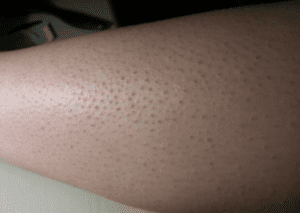 علاج جلد الوزه بالادويه - skin-beauty جلد الوزه بالادويه 2 300x213 - علاج جلد الوزه بالادويه