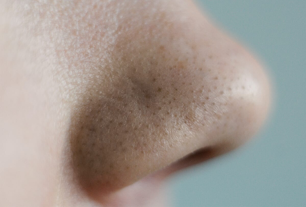 clogged pores feat - انسداد المسام: الأسباب والعلاج والعلاجات المنزلية والرعاية الذاتية