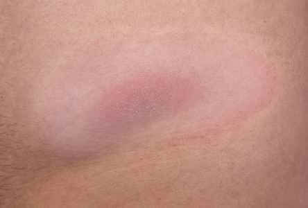 Borreliose: Stadien, Symptome und Präventionstipps - Allergie-Immunität Borreliose Borreliose - Borreliose: Stadien, Symptome und Tipps zur Vorbeugung