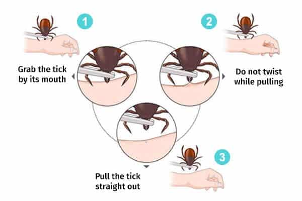 removing a tick - مرض لايم: المراحل والأعراض ونصائح الوقاية