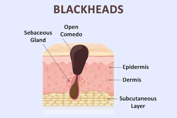 blackheads formation - كيفية التخلص من الرؤوس السوداء في الأذنين