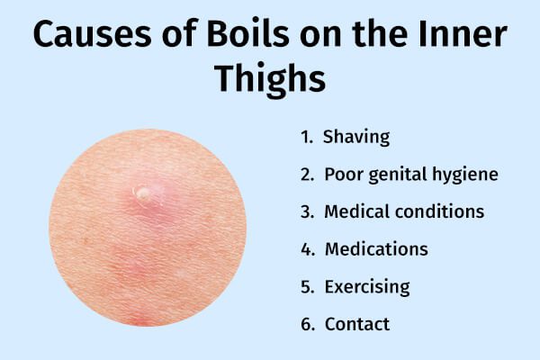 كيفية منع وعلاج الدمامل على الفخذين الداخليين - skin-beauty causes of boils - كيفية منع وعلاج الدمامل على الفخذين الداخليين