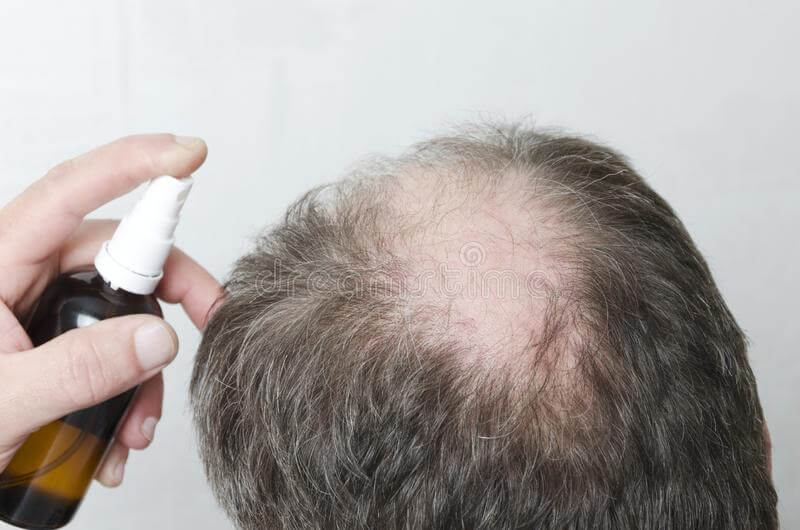 6 علاجات منزلية لزيادة نمو الشعر وكيفية استخدامها - %categories