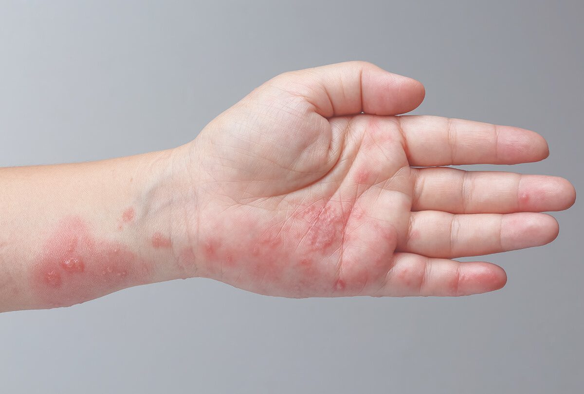 الجرب: الأسباب والأعراض والعلاج والمضاعفات - skin-beauty causes and symptoms for scabies feat - الجرب: الأسباب والأعراض والعلاج والمضاعفات