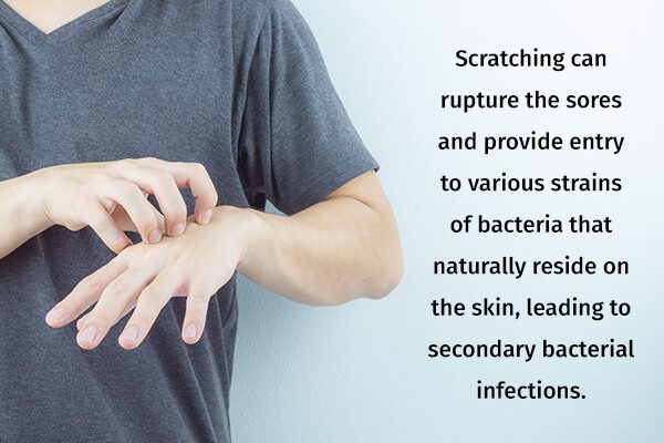 الجرب: الأسباب والأعراض والعلاج والمضاعفات - skin-beauty complications associated with scabies - الجرب: الأسباب والأعراض والعلاج والمضاعفات