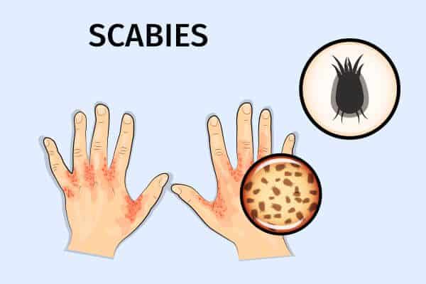 الجرب: الأسباب والأعراض والعلاج والمضاعفات - skin-beauty mode of transmission for scabies - الجرب: الأسباب والأعراض والعلاج والمضاعفات
