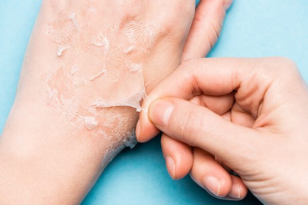 7 علاجات منزلية لتجاعيد اليدين وكيفية استخدامها - skin-beauty peels to manage hand wrinkles - 7 علاجات منزلية لتجاعيد اليدين وكيفية استخدامها