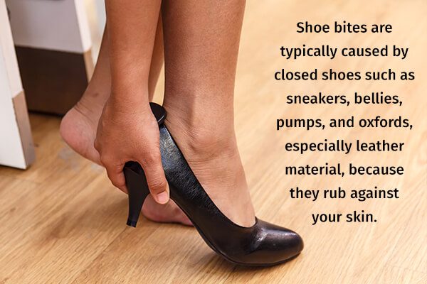 فقاعات القدم بسبب لدغات الأحذية: 7 نصائح سهلة لتجنب ذلك - skin-beauty specific type of footwear that causes shoe bites - فقاعات القدم بسبب لدغات الأحذية: 7 نصائح سهلة لتجنب ذلك