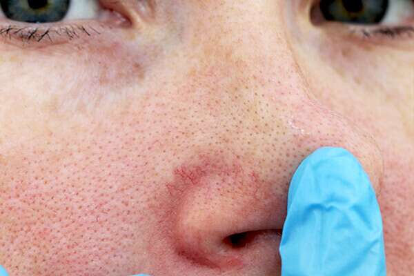 العد الوردي : الأسباب والأعراض وعوامل الخطر والعلاج والرعاية الذاتية - skin-beauty risk factors for rosacea 600x400 - العد الوردي : الأسباب والأعراض وعوامل الخطر والعلاج والرعاية الذاتية