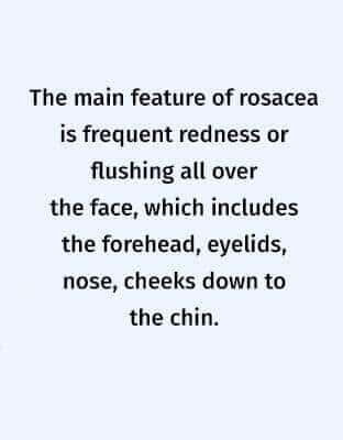 العد الوردي : الأسباب والأعراض وعوامل الخطر والعلاج والرعاية الذاتية - skin-beauty symptoms of rosacea 600x400 e1637325378175 - العد الوردي : الأسباب والأعراض وعوامل الخطر والعلاج والرعاية الذاتية