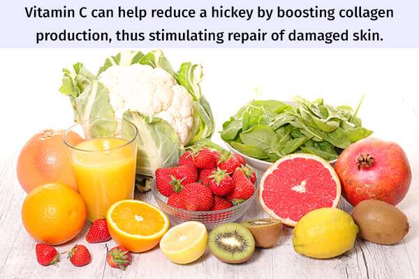 vitamin c to get rid of hickeys 600x400 - تخلص من الهيكي: 10 علاجات منزلية وطرق لإخفائها