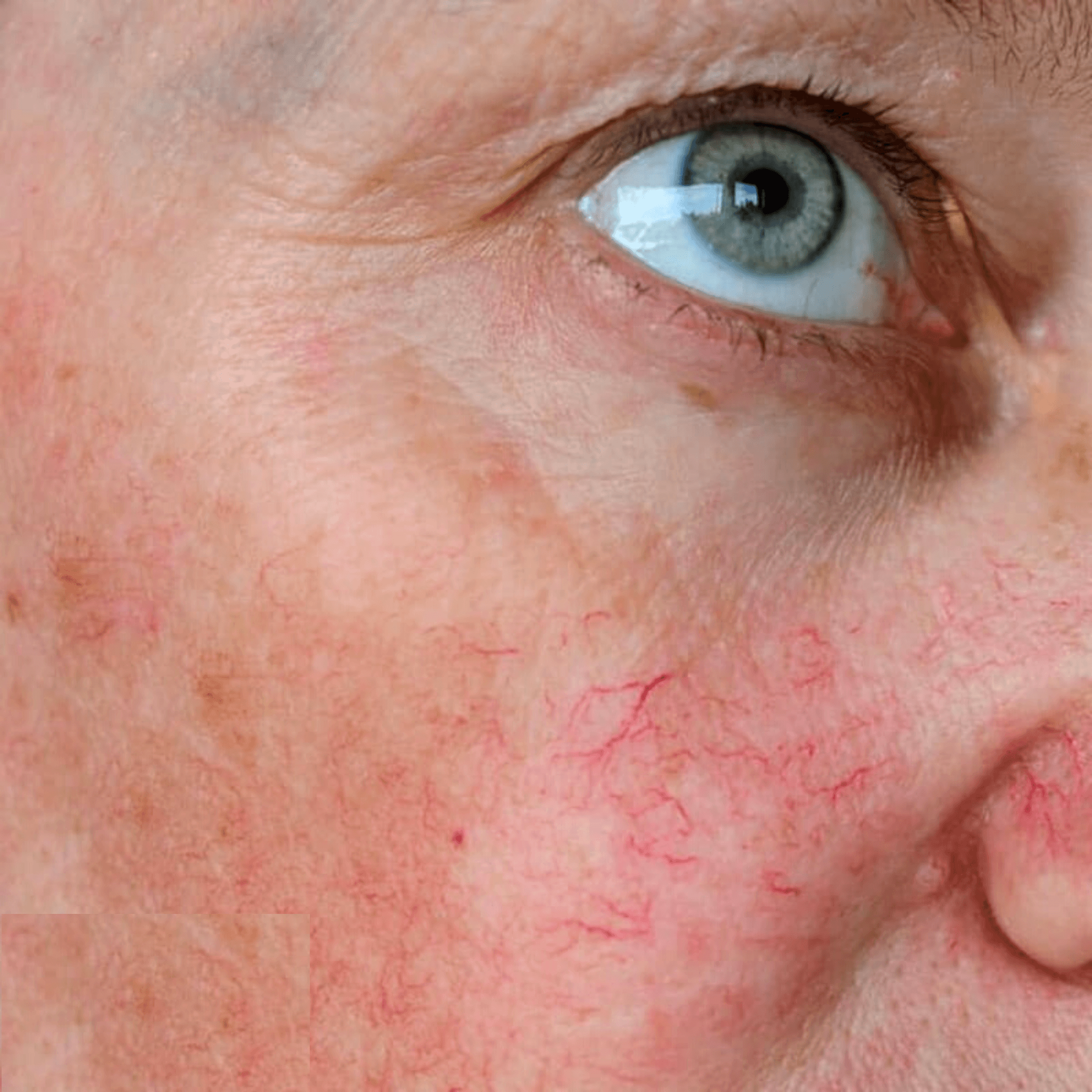 muelle pasta al revés Qué causa la rotura de capilares en tu rostro y cómo tratarlo | la mejor  casa
