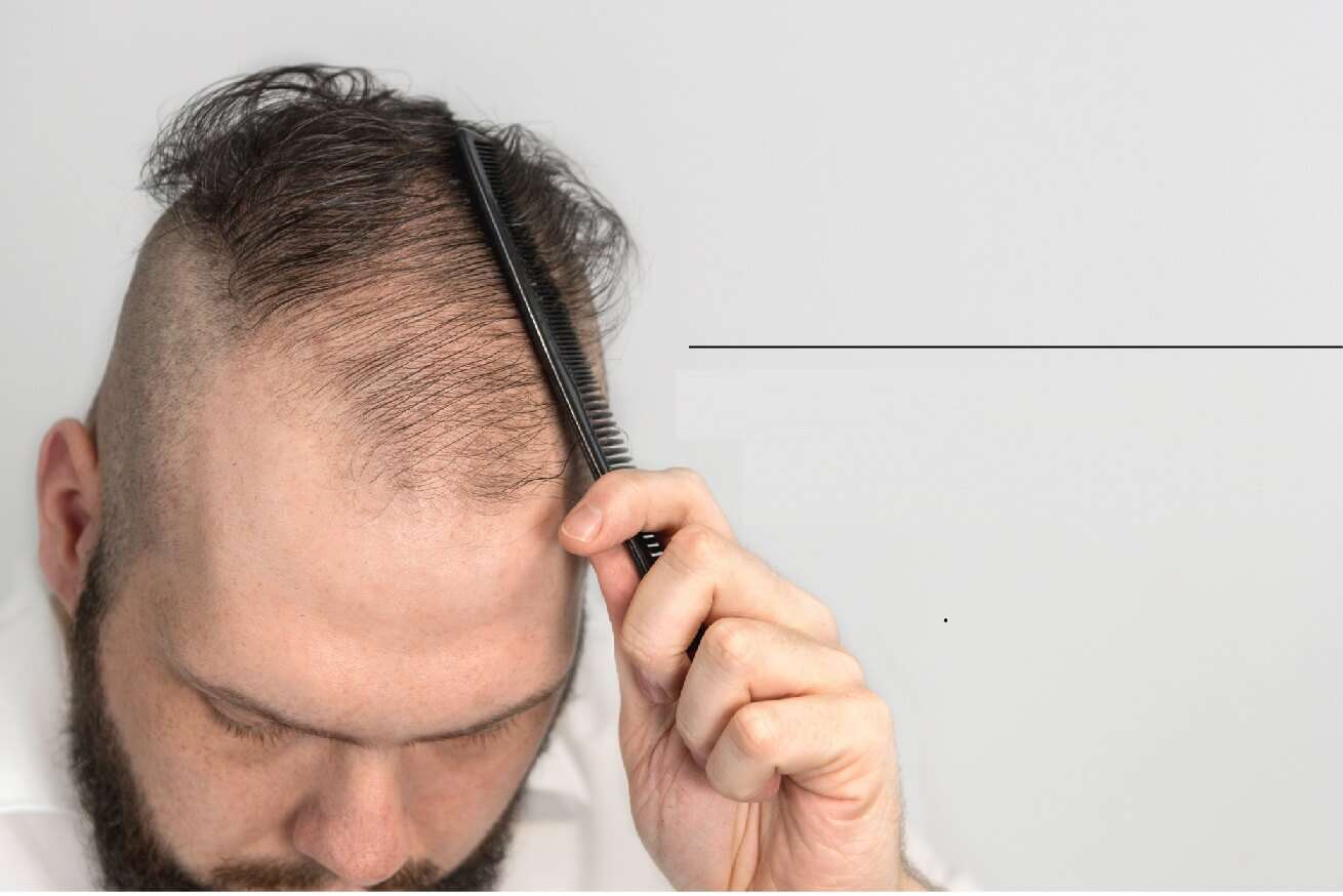 كيف تساعد على تكثيف نمو الشعر الضعيف - %categories