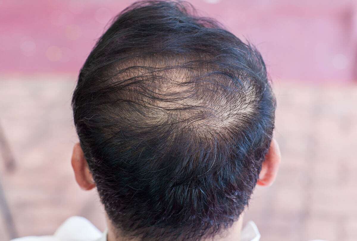 تساقط الشعر: الأسباب ، أنواعه ، والعلاج - %categories