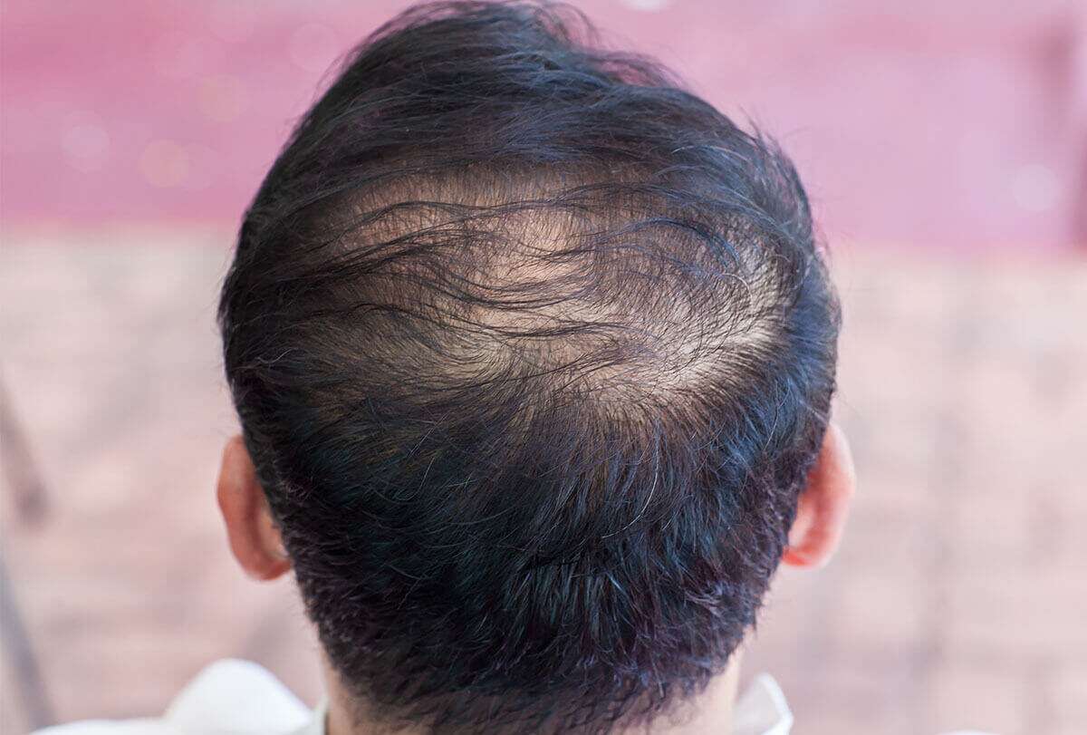 Chute de cheveux : causes, types et traitement - skin-beauty arrêter l'amincissement des cheveux et prévenir la calvitie exploit 1 1200x811 - Chute de cheveux : causes, types et traitement