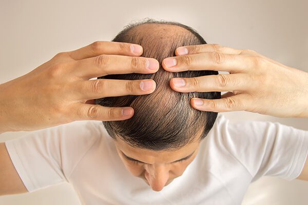8 علاجات منزلية لمنع تساقط الشعر عند الرجال ونموه بسرعة - %categories