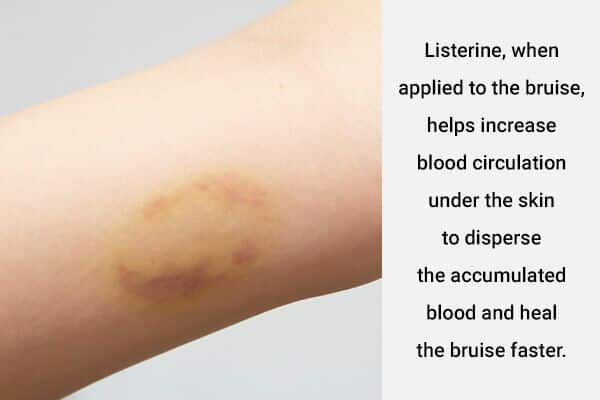 12 استخدامات مدهشة لغسول الفم ليسترين لمشاكل الجلد الشائعة - skin-beauty listerine for bruising 600x400 - 12 استخدامات مدهشة لغسول الفم ليسترين لمشاكل الجلد الشائعة