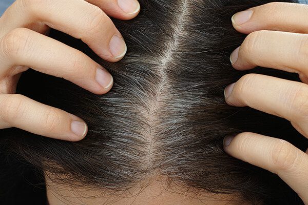 premature hair graying definition and causes - عصير البصل لشيب الشعر: كيف يعمل وكيف يتم استخدامه