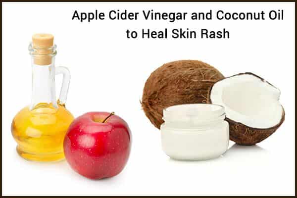 6 طرق لاستخدام خل التفاح لعلاج الطفح الجلدي - skin-beauty apple cider vinegar coconut oil to heal a skin rash 600x400 - 6 طرق لاستخدام خل التفاح لعلاج الطفح الجلدي