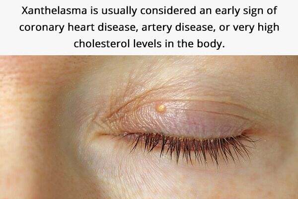طرق التعامل مع رواسب الكوليسترول حول عينيك - skin-beauty cholesterol deposits around the eyes are a warning of coronary heart disease 600x400 - طرق التعامل مع رواسب الكوليسترول حول عينيك