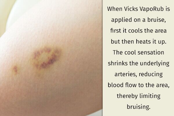 vicks-vaporub-fades-bruises-600x400 9 استخدامات مفاجئة لـ فيكس فابوراب بعد نزلات البرد