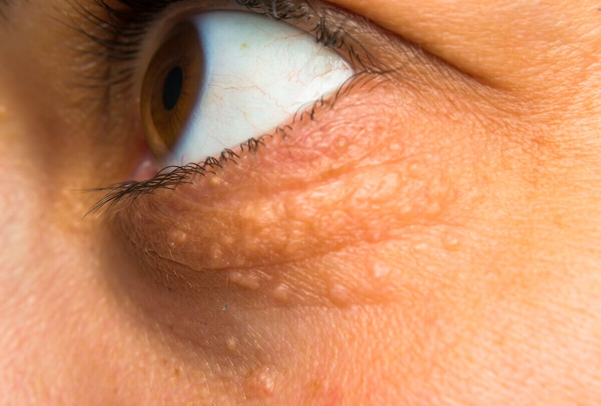 طرق التعامل مع رواسب الكوليسترول حول عينيك - %categories