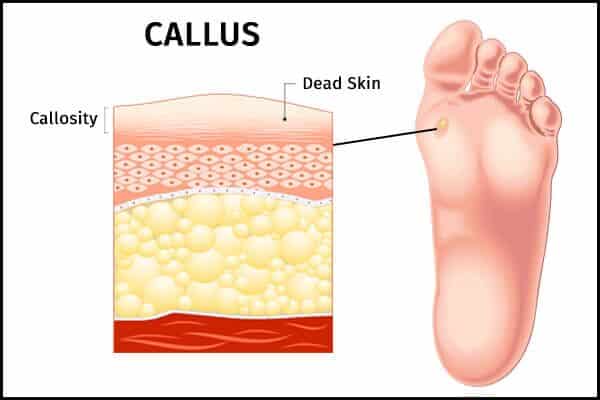طرق طبيعية لإزالة نسيج مسمار اللحم في المنزل - skin-beauty calluses symptoms 600x400 - طرق طبيعية لإزالة نسيج مسمار اللحم في المنزل