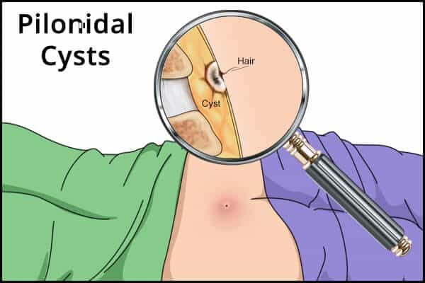 diagnosis of pilonidal cysts 600x400 - 9 العلاجات المنزلية لكيسات الناسور العصعصي (الناسور الشعري)