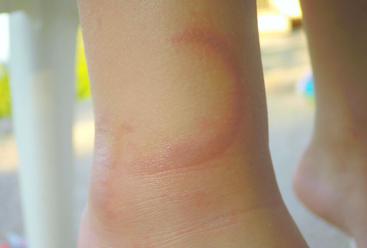 علاج لسعات قنديل البحر - skin-beauty home remedies to manage jellyfish stings feat 1200x811 - علاج لسعات قنديل البحر