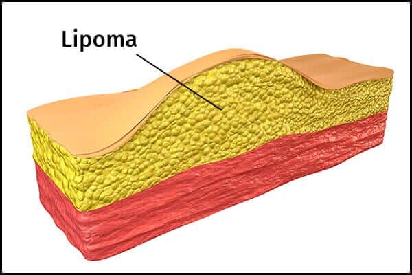 5 علاجات منزلية لتقليل الورم الشحمي - skin-beauty lipoma cause 600x400 - 5 علاجات منزلية لتقليل الورم الشحمي