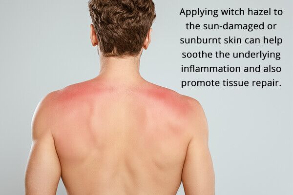 uses witch hazel to reduces sunburn and skin damage 600x400 - 9 استخدامات مذهلة من بندق الساحرة لم تفكر بها أبدًا