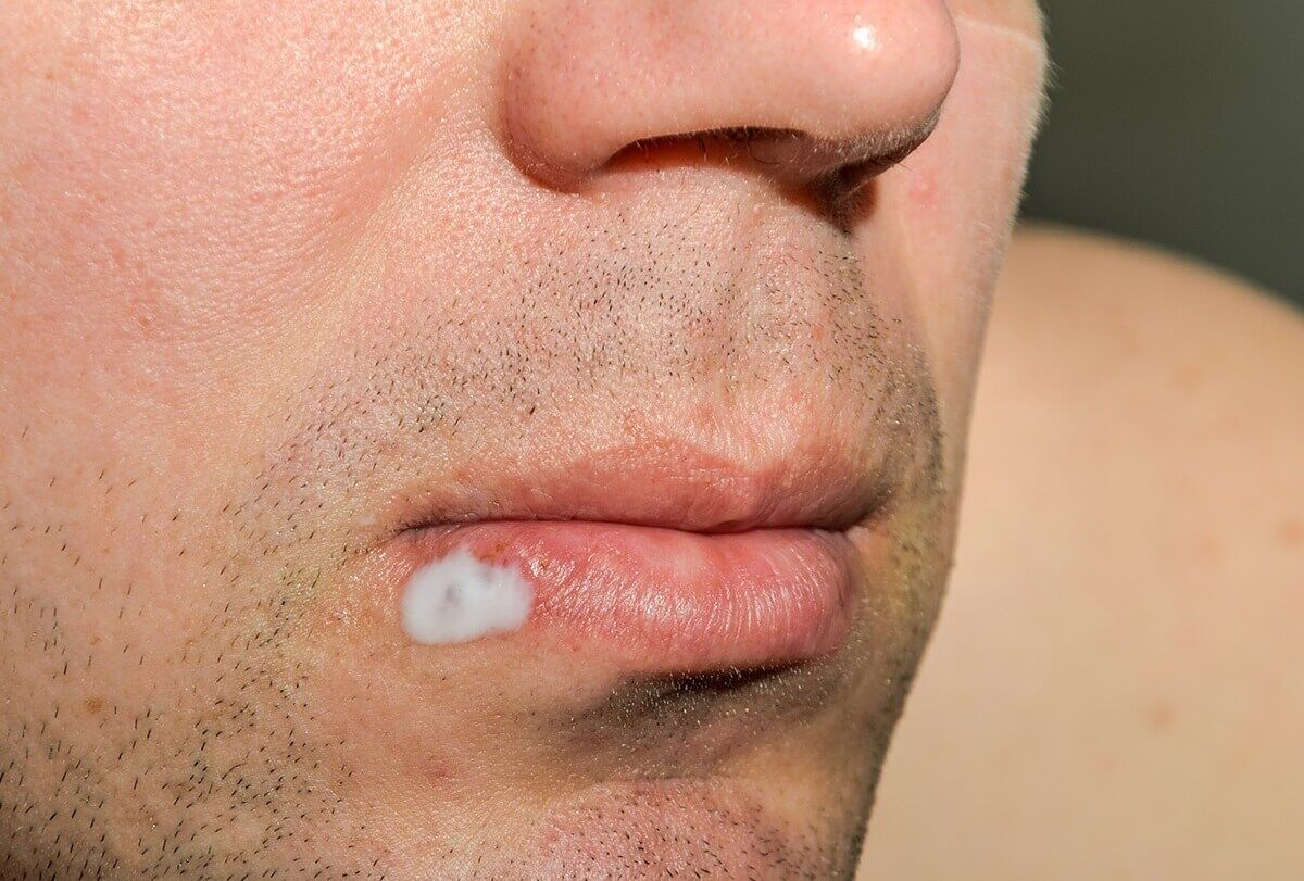 7 علاجات منزلية لعدوى الهربس وكيفية استخدامها - skin-beauty home remedies for herpes feat 1200x811 - 7 علاجات منزلية لعدوى الهربس وكيفية استخدامها