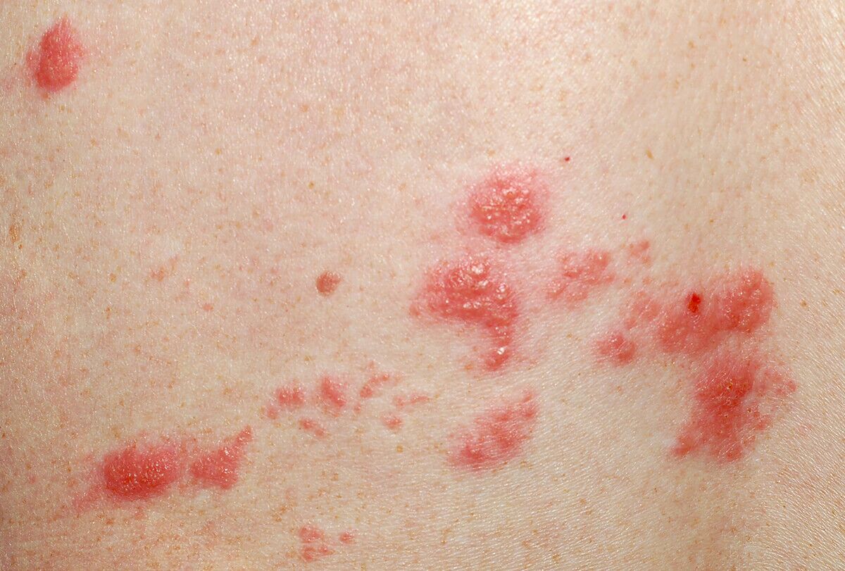 6 العلاجات المنزلية للقوباء المنطقية وكيفية استخدامها - skin-beauty home remedies for shingles feat 1200x811 - 6 العلاجات المنزلية للقوباء المنطقية وكيفية استخدامها