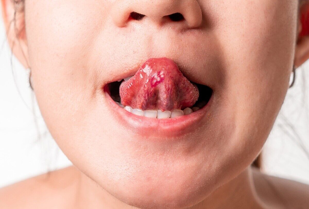 10 علاجات منزلية لحبوب آخر اللسان - skin-beauty home remedies to get rid of tongue blisters feat 1200x811 - 10 علاجات منزلية لحبوب آخر اللسان