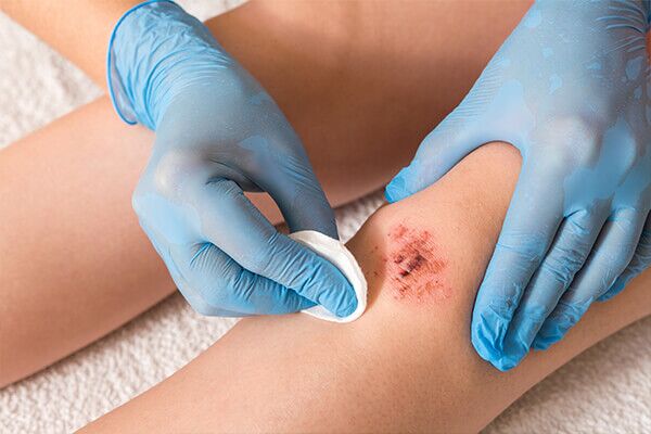 use-your-natural-first-aid-items-for-cuts-grazes-and-skin-abrasions-600x400 كيفة تحضير مجموعة الإسعافات الأولية الطبيعية