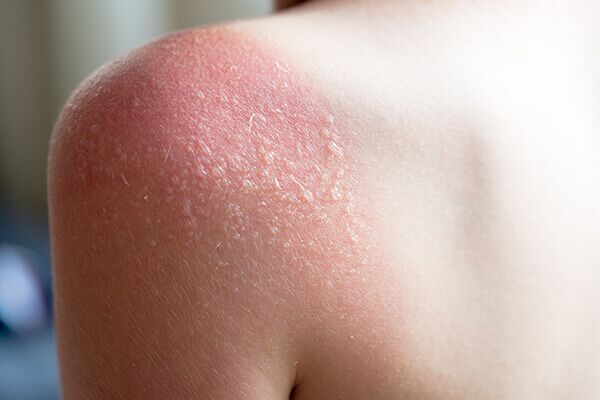 use-your-natural-first-aid-items-for-minor-burns-and-sunburn-600x400 كيفة تحضير مجموعة الإسعافات الأولية الطبيعية