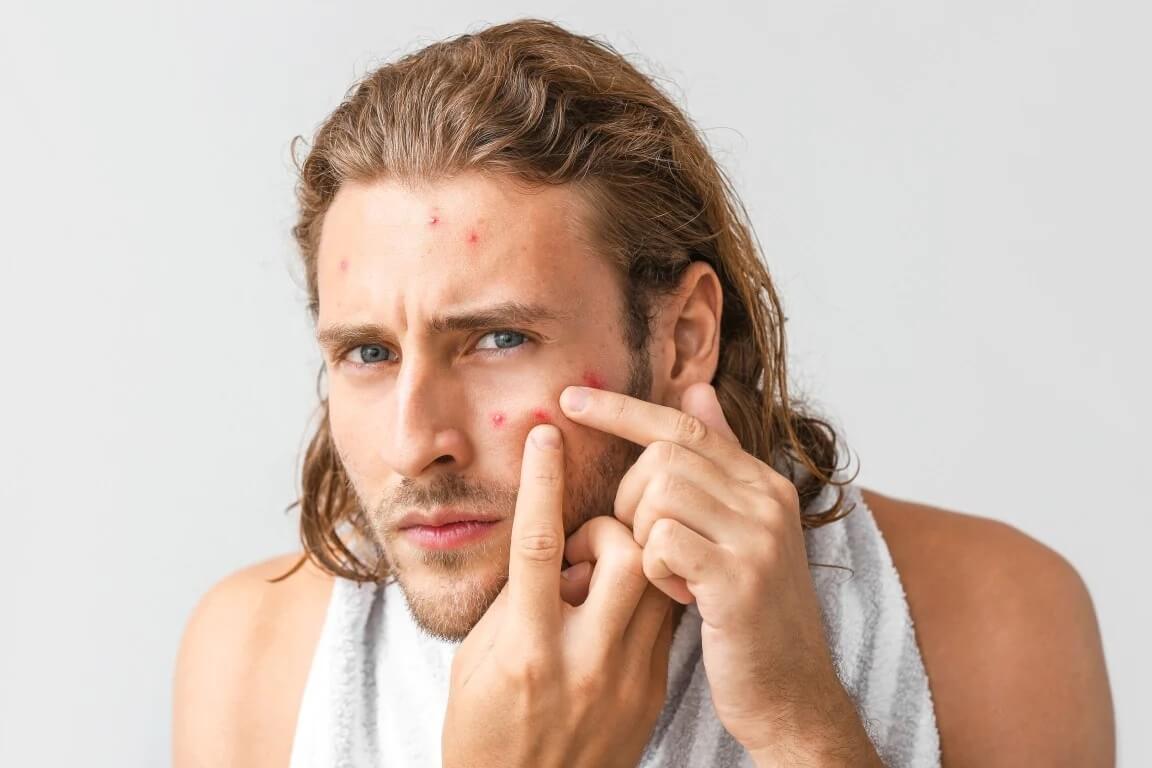 أفضل مكونات المطبخ لمحاربة حب الشباب - skin-beauty acne in men بثقبث 1152x768 - أفضل مكونات المطبخ لمحاربة حب الشباب